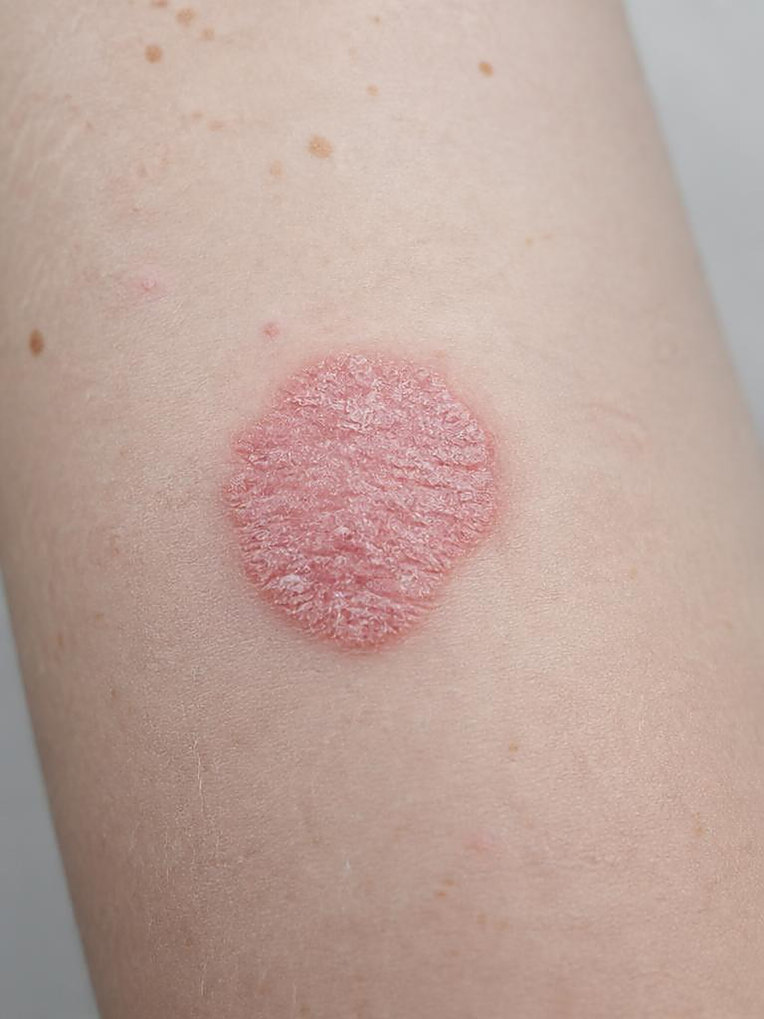 Macrofotografia clínica de placa eritematodescamativa em pele muito clara