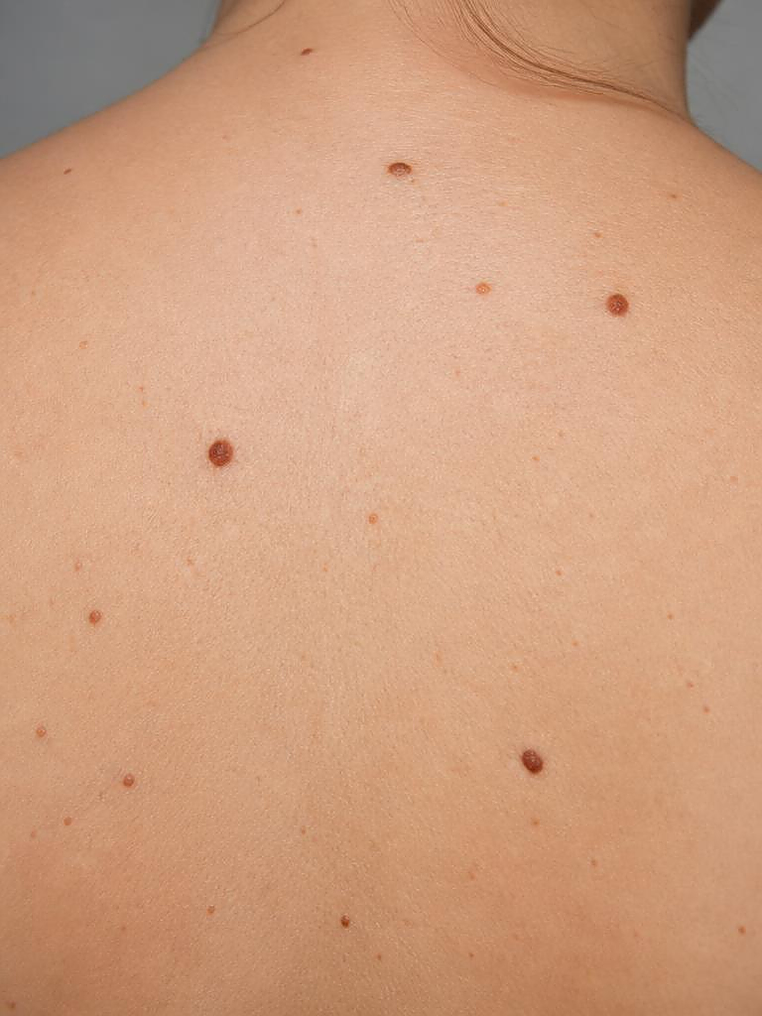 Macrofotografia clínica de lesões melanocíticas em pele clara