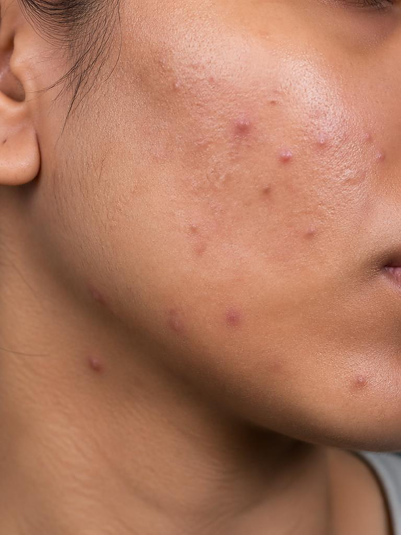 Macrofotografia clínica de lesões acneicas inflamatórias em pele bege intermediária
